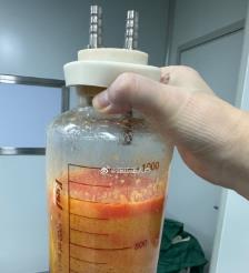 长治水动力吸脂手术要做多久？